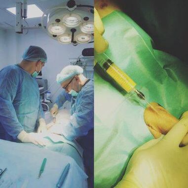 Penis kalınlaşması ameliyatla mümkündür