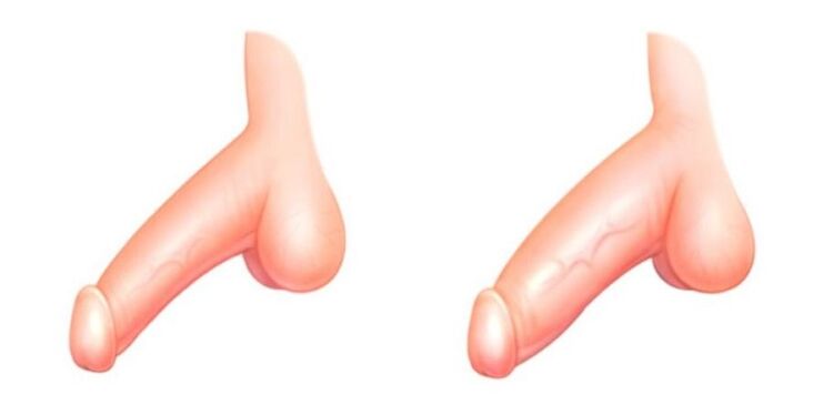 Penis büyütmeden önce ve sonra